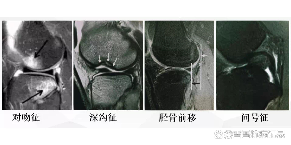 前交叉韧带核磁解剖图图片