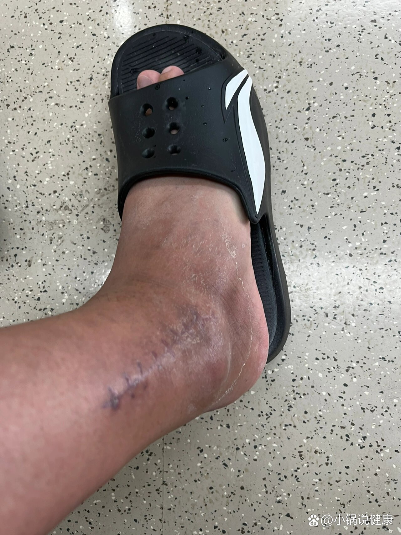 右踝骨折-一月拖拐