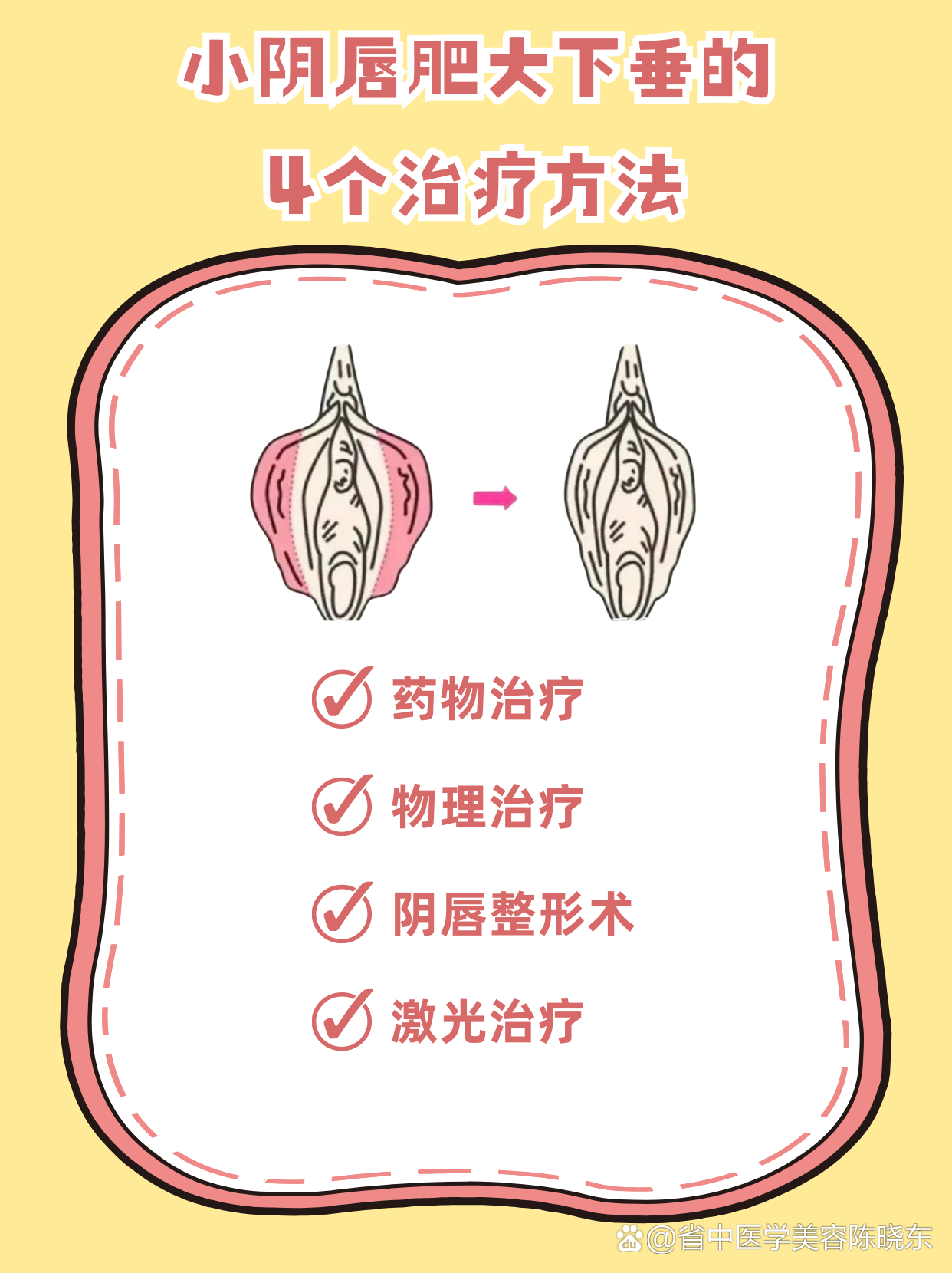 小阴唇 小阴唇肥大下垂的4个治疗方法