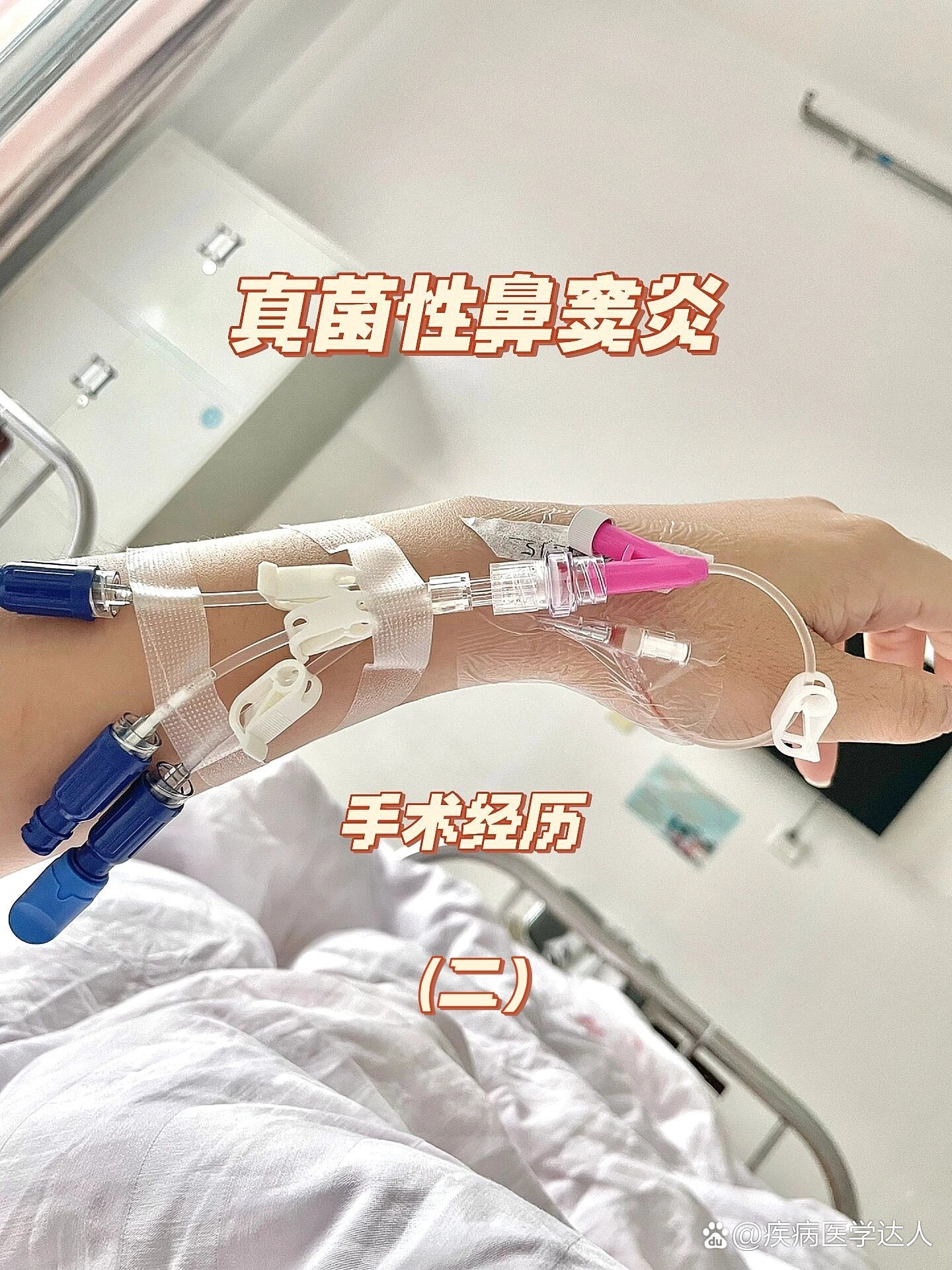 真菌性鼻窦炎手术经历分享(二)95