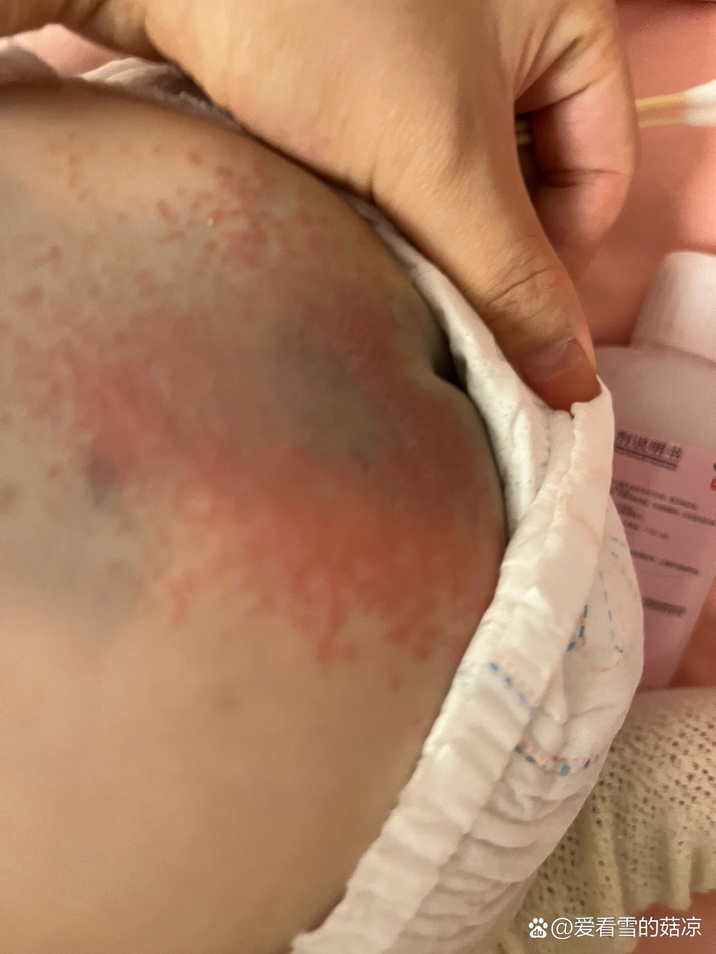 屁股上的湿疹不知道怎么办啦?