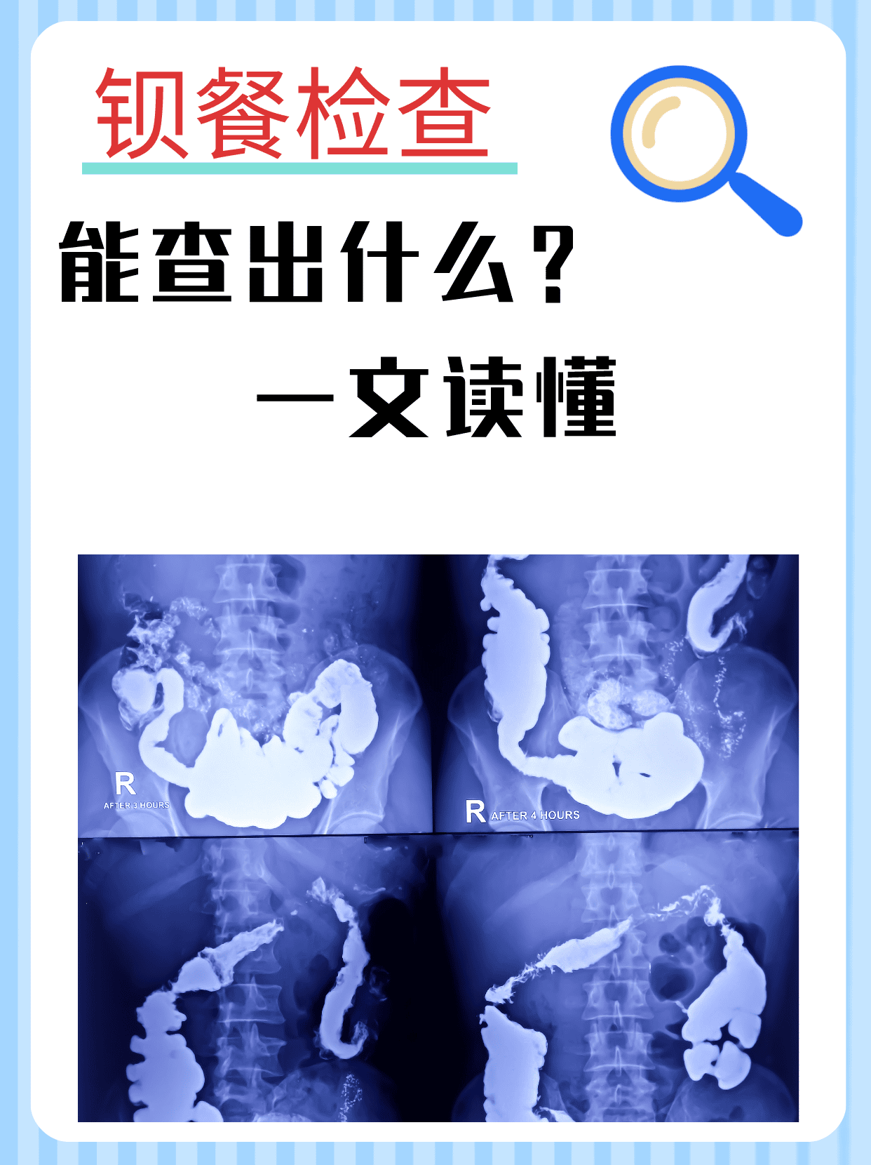 钡餐检查能查出什么?一文读懂