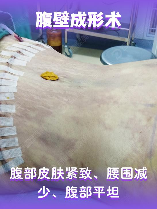腹壁成形术