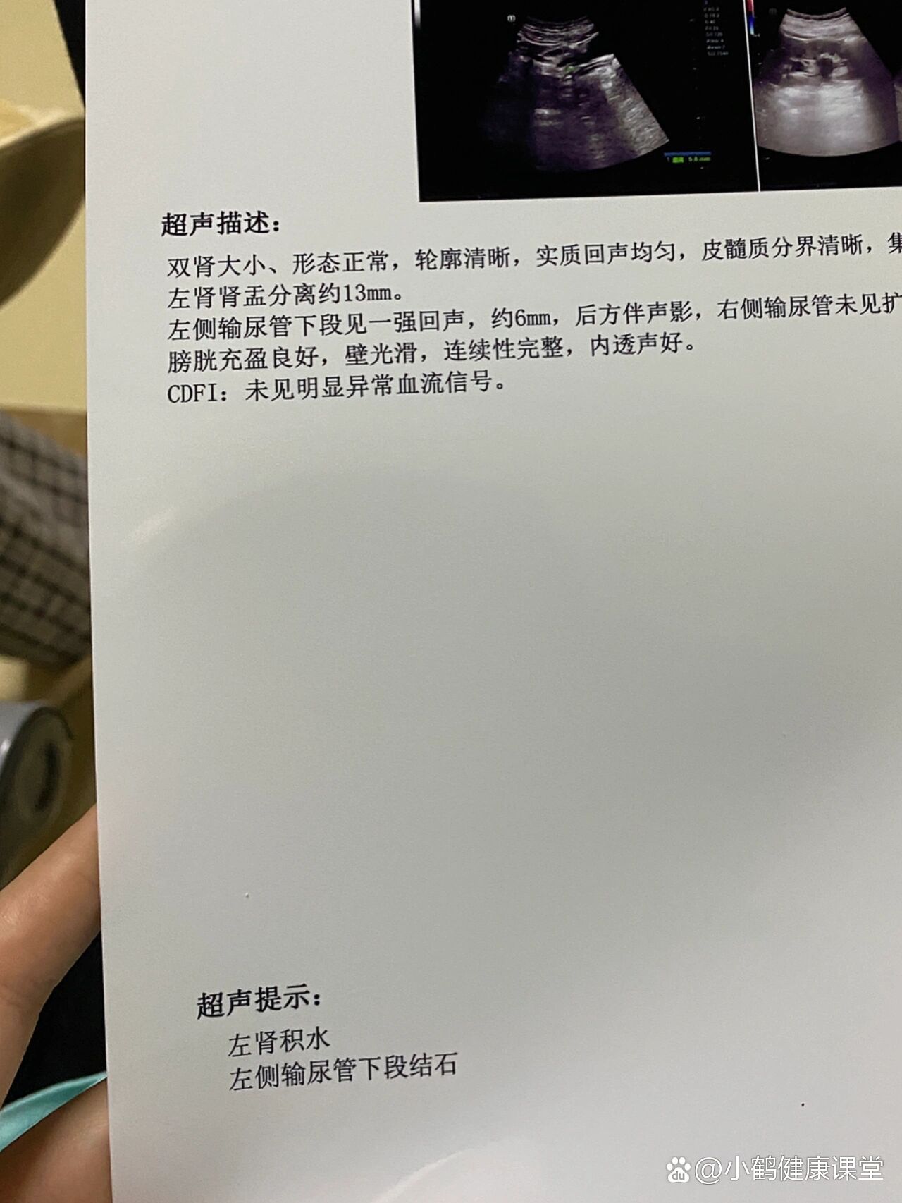 第一次左侧输尿管下侧结石