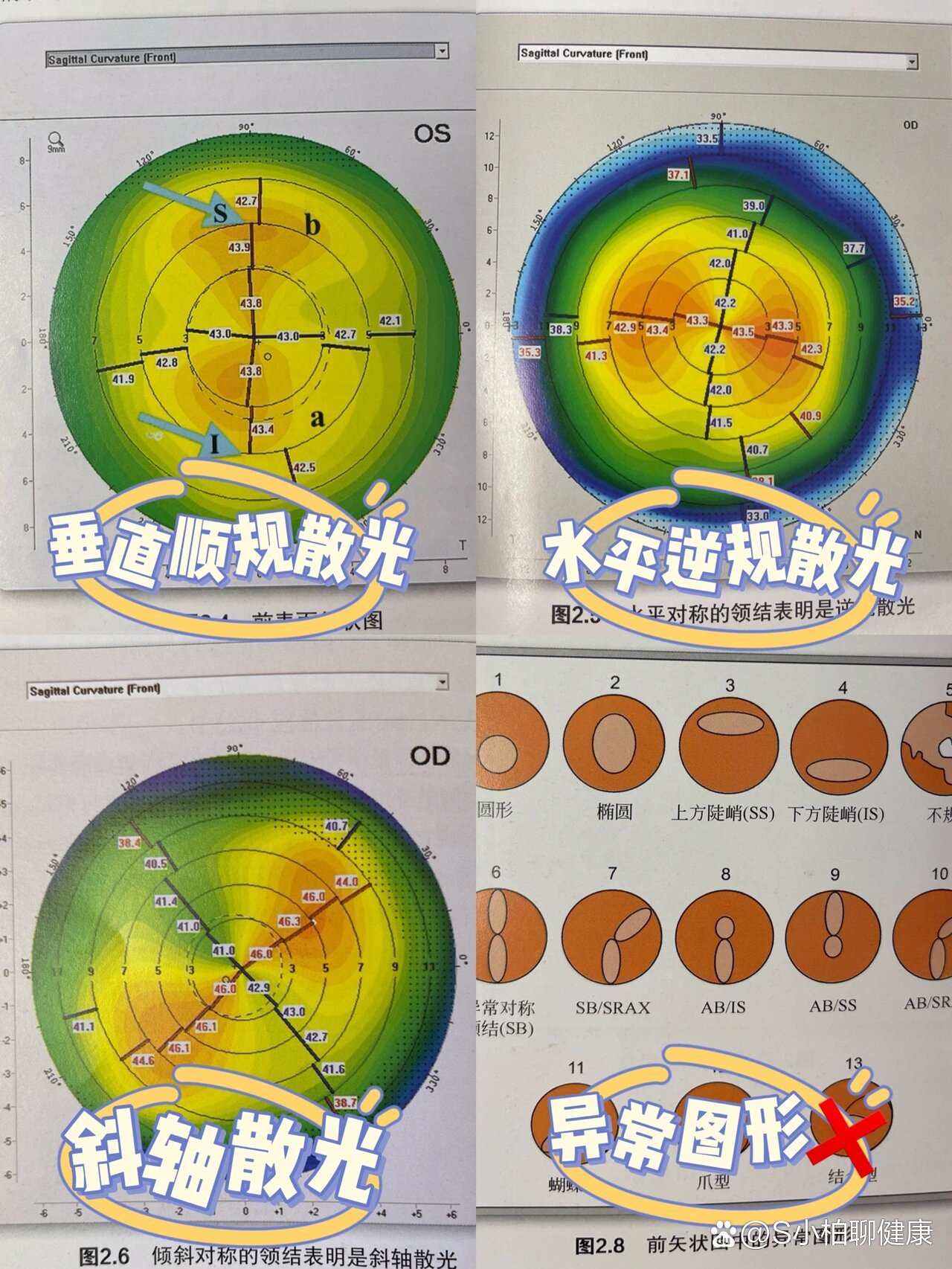 角膜地形图的解读图片