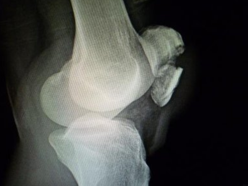 paget骨病,又称畸形性骨炎或变形性骨炎,为一种罕见代谢性骨病 - page