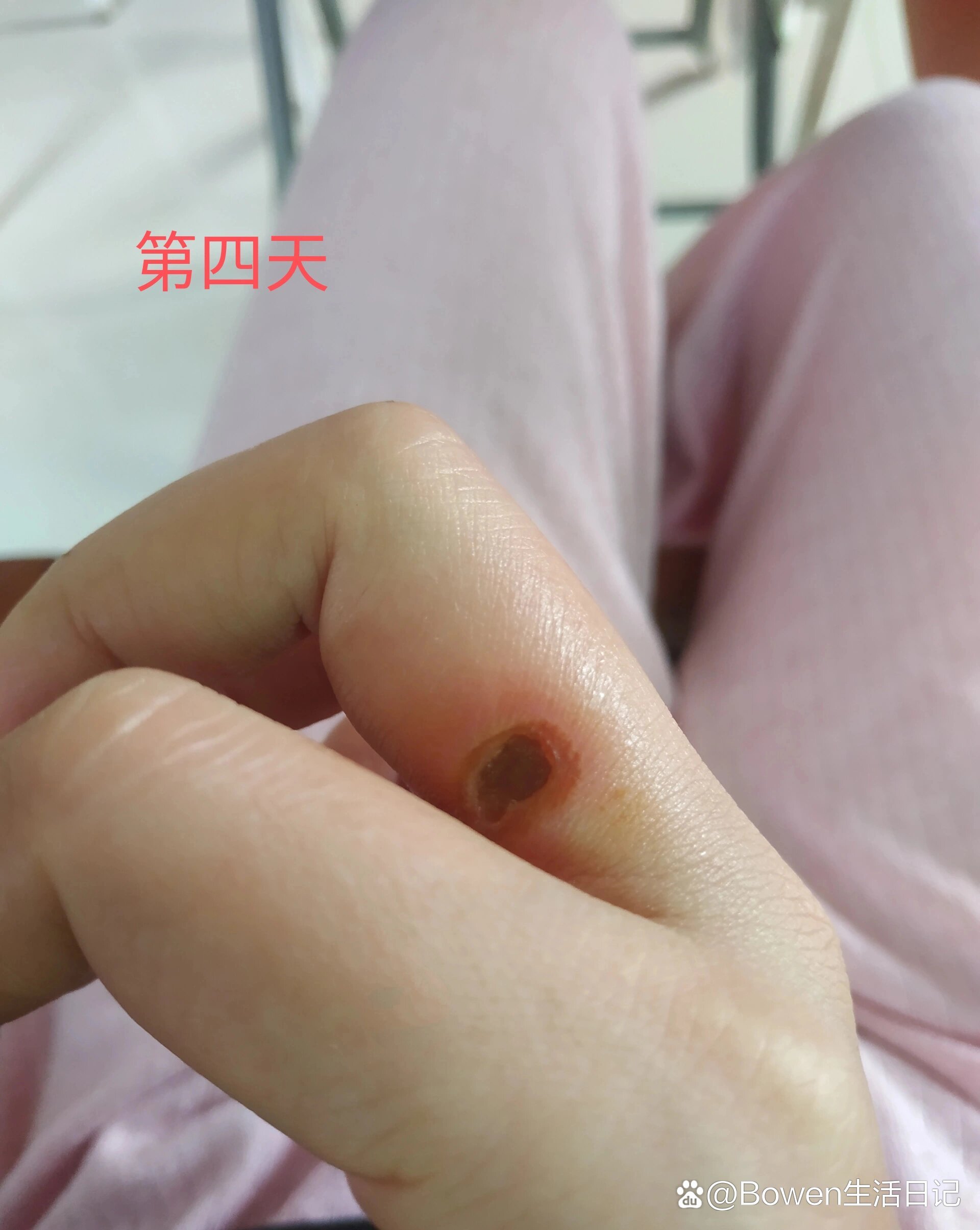 被热油烫伤起水泡后把皮撕掉了