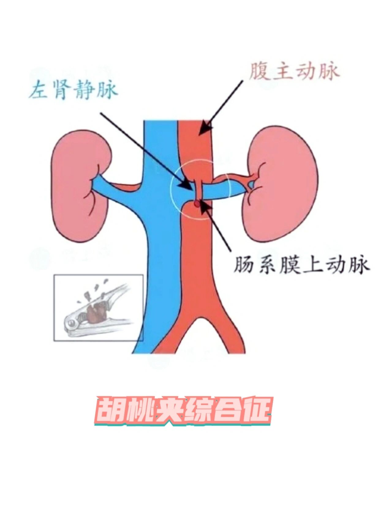 胡桃夹综合征-左肾静脉受压综合征!