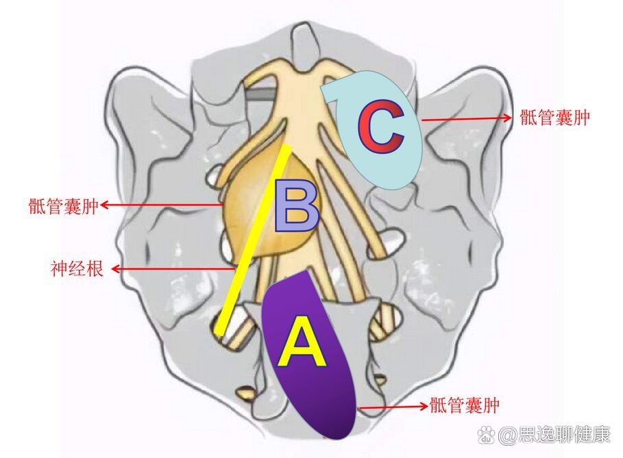 骶管囊肿位置图片图片