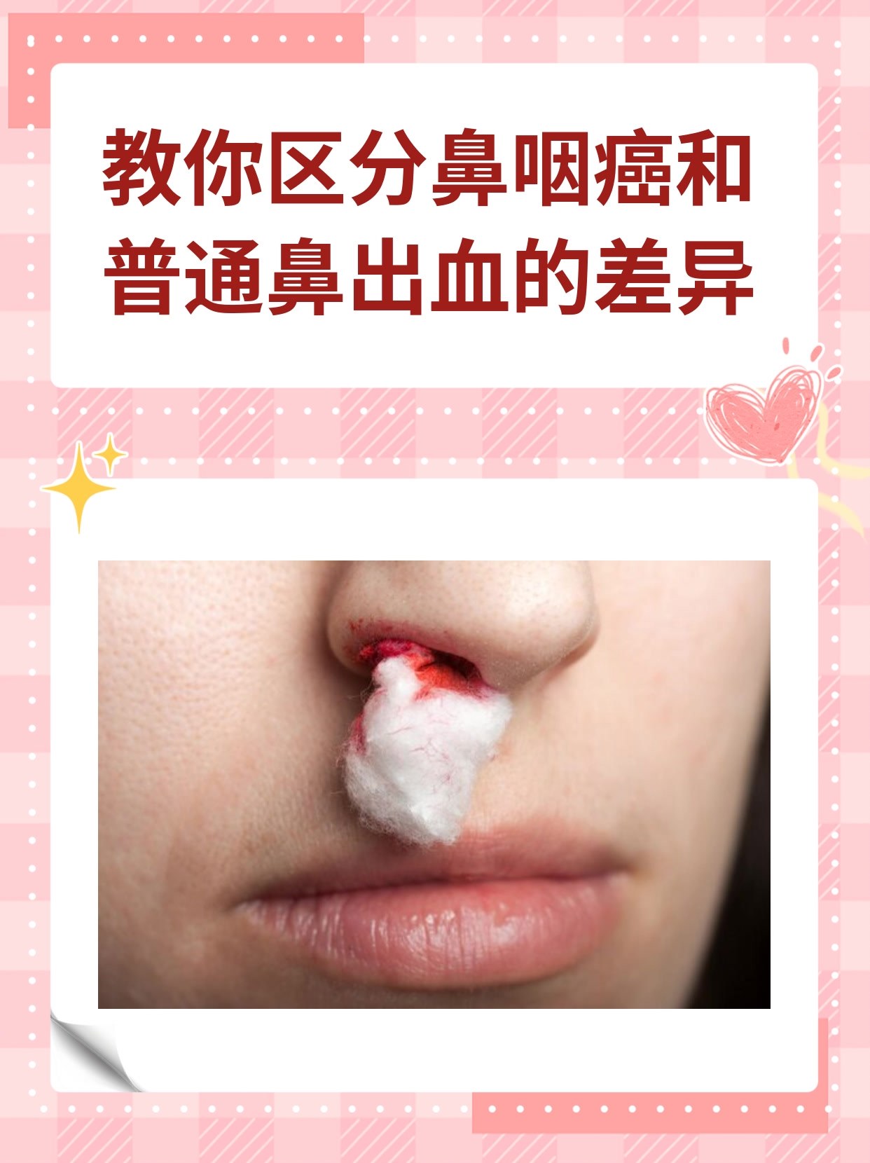 教你区分鼻咽癌和普通鼻出血的差异