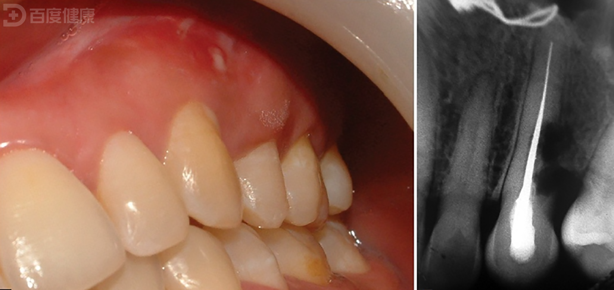 活髓切断治疗年轻恒牙根尖周炎一例 - 知乎