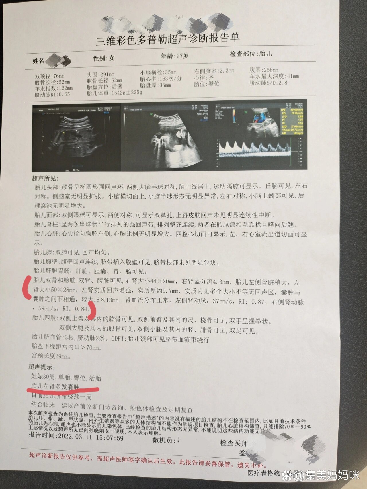 前期孕检一样不落全部绿灯通过30周小排畸突然查出胎儿左肾多发囊肿