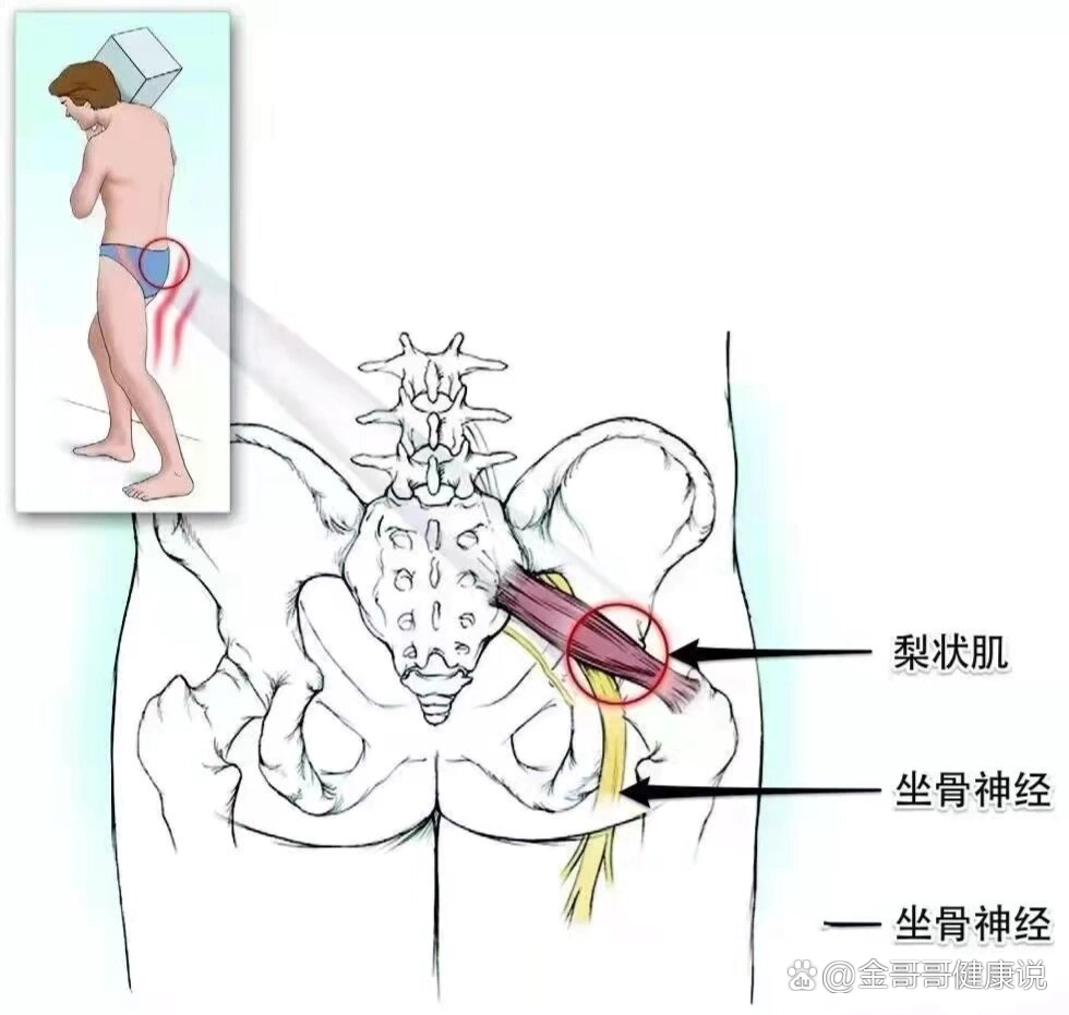 什么是梨状肌综合征?