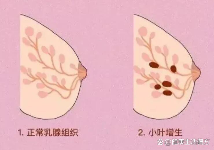 乳腺小叶增生