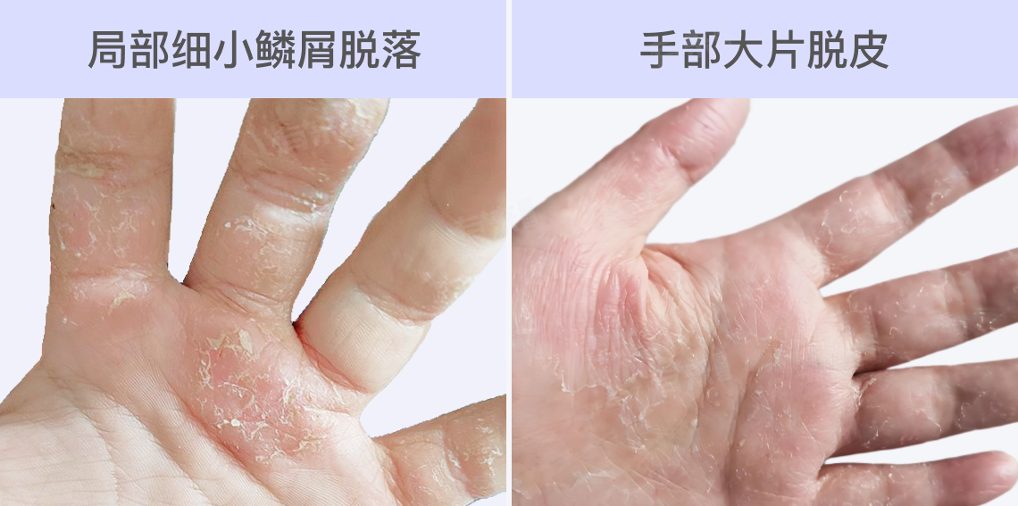 汗疱疹的症状是什么样的