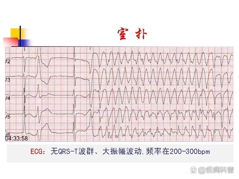 室颤室扑心电图特点图片