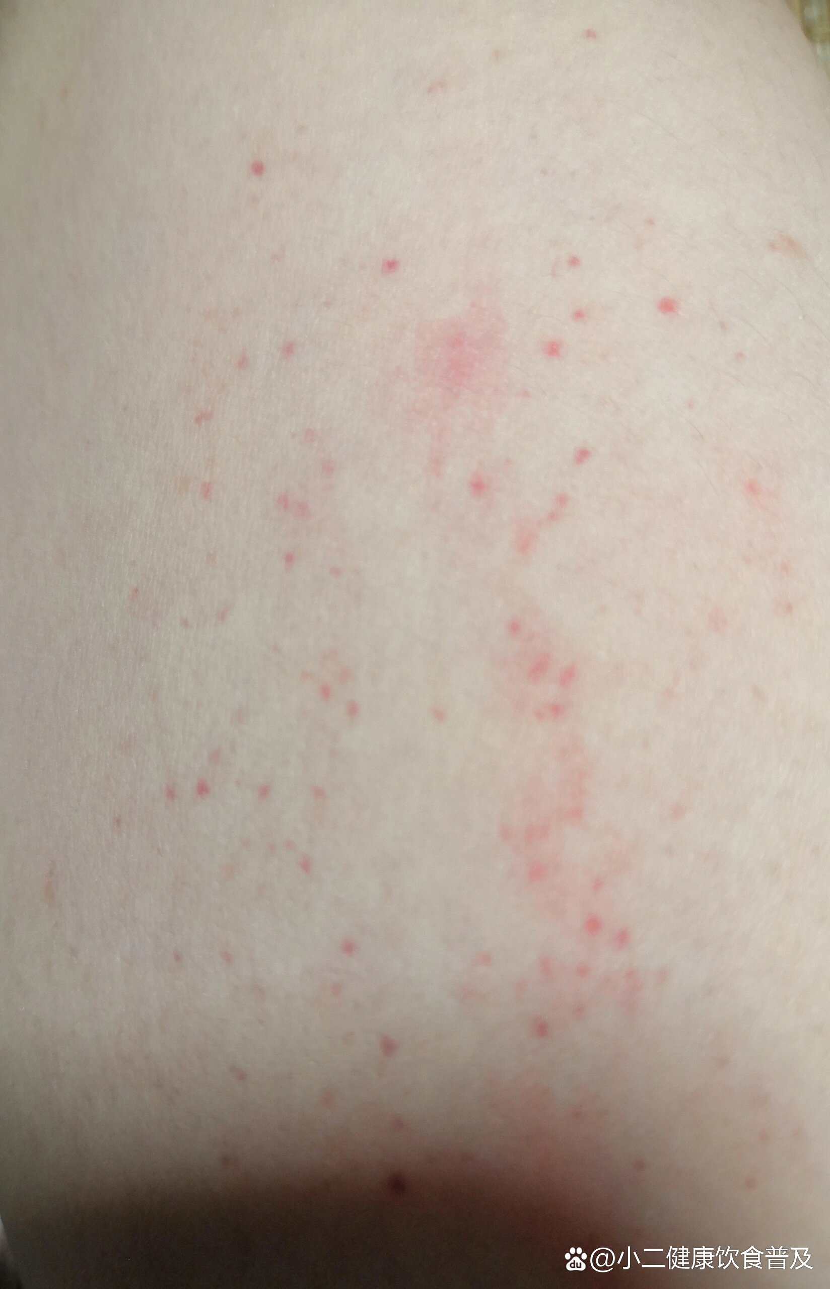 胳膊内侧的小红点