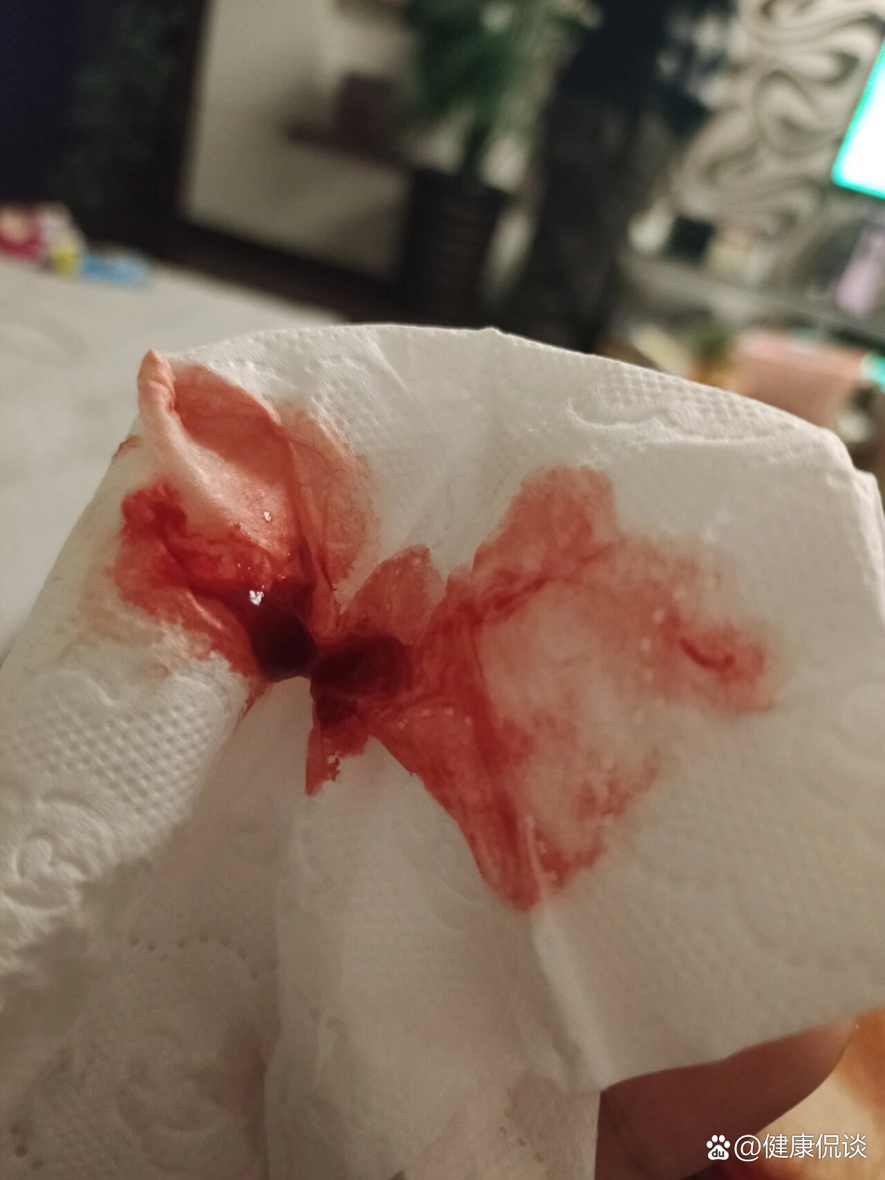 阳了嗓子肿大出血