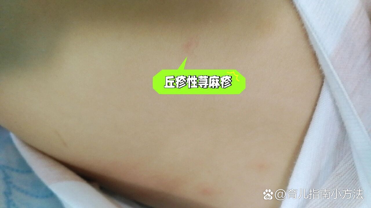 婴儿丘疹性荨麻疹图片