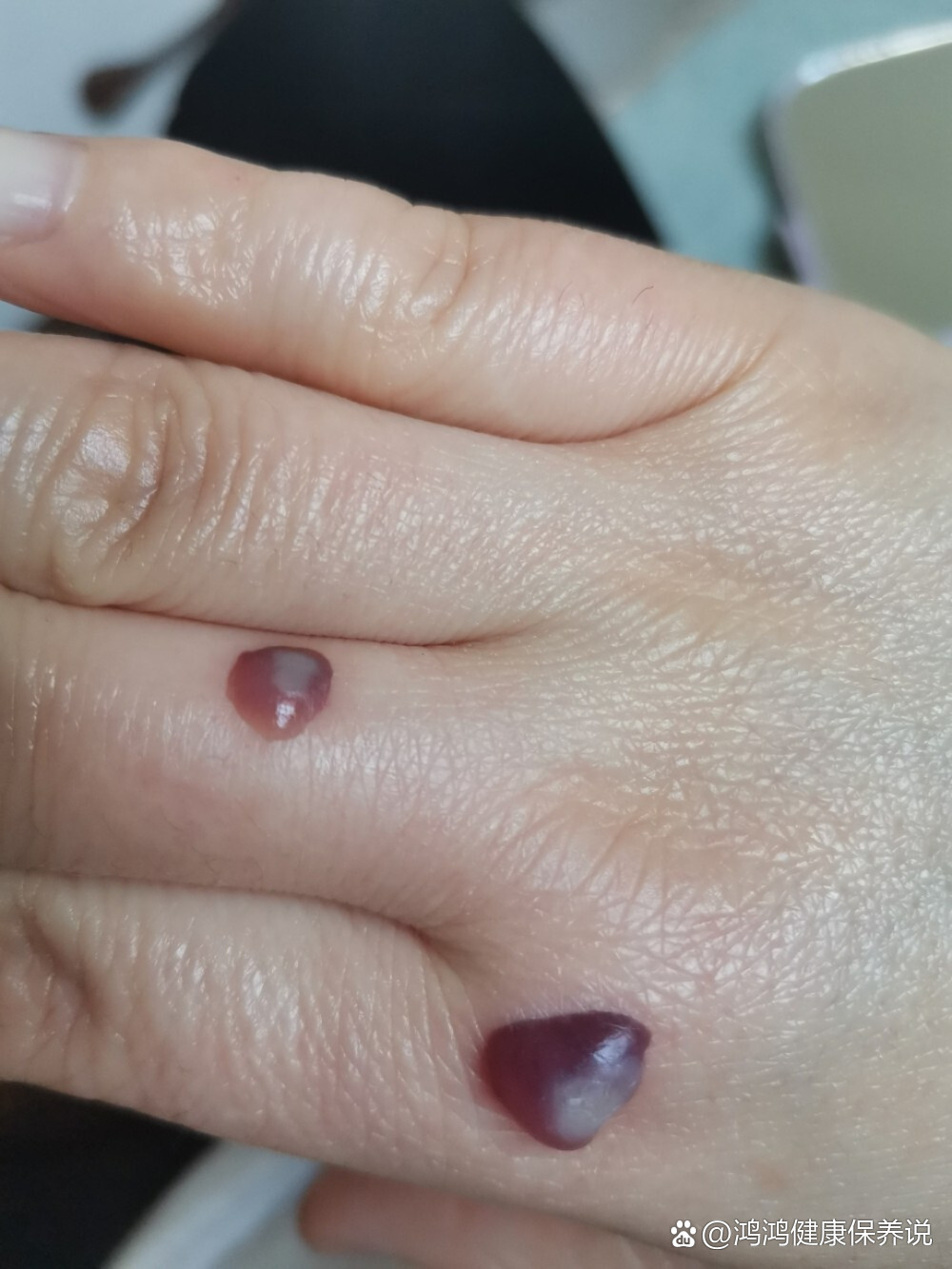 液氮冷冻1小时后起了血泡,需不需要刺破,求指导,谢谢!