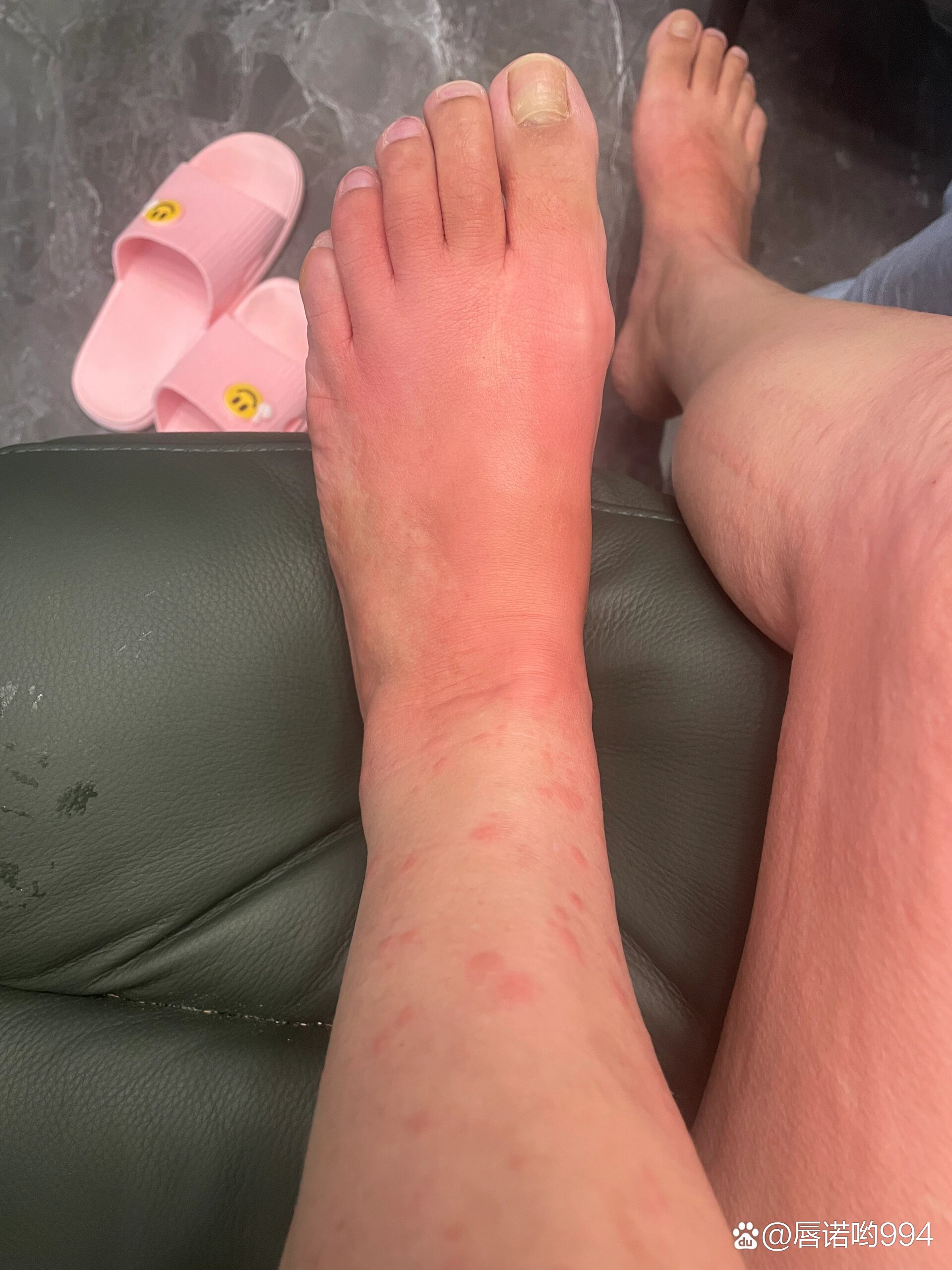 第一次被蚂蚁咬了会全身过敏,真毒的92