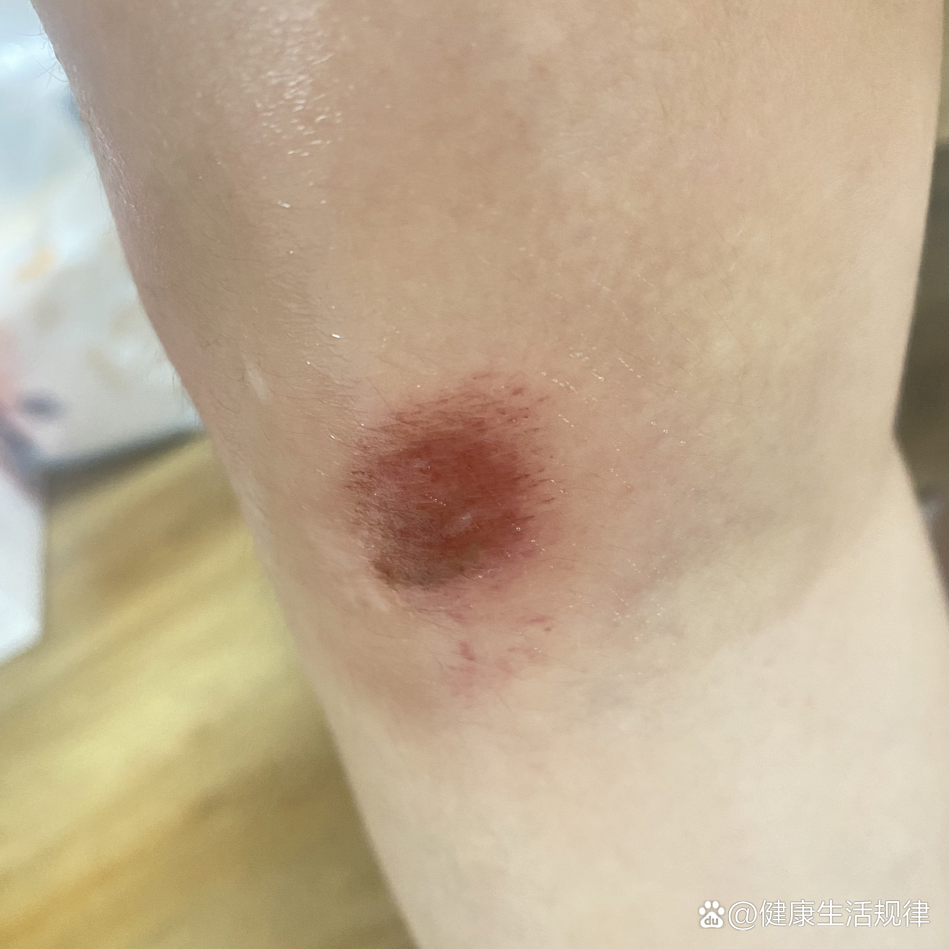 膝盖摔伤第二天,如何快速恢复正常行走