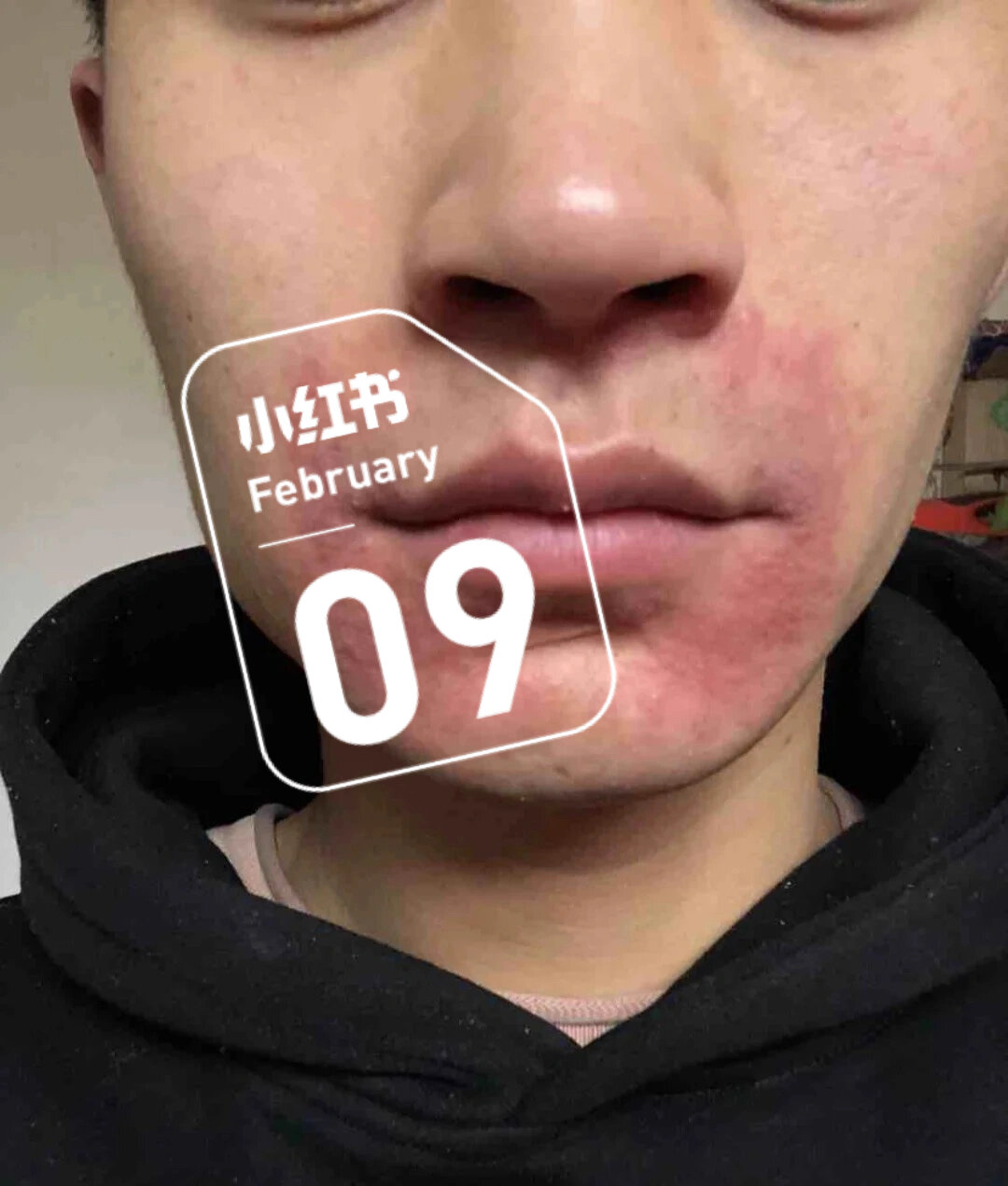口周皮炎