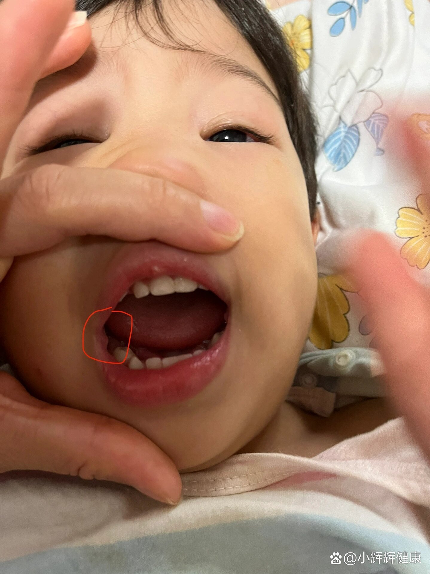宝宝口腔内两侧长得小疙瘩,这是啥啊?