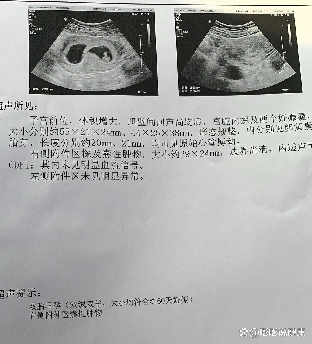 孕8周双绒双羊b超