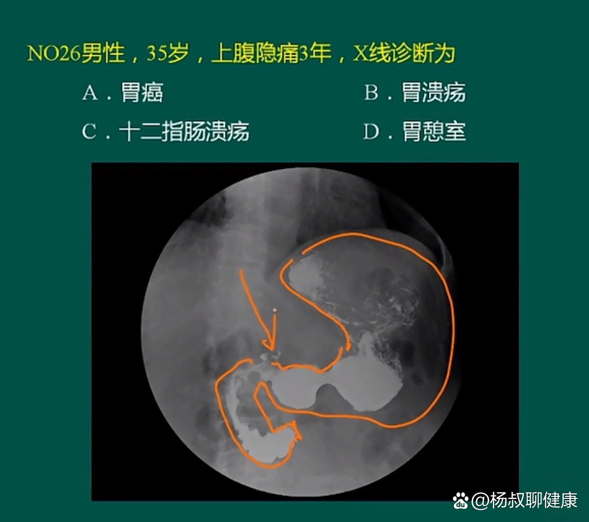 腹部x线钡餐造影(5种)