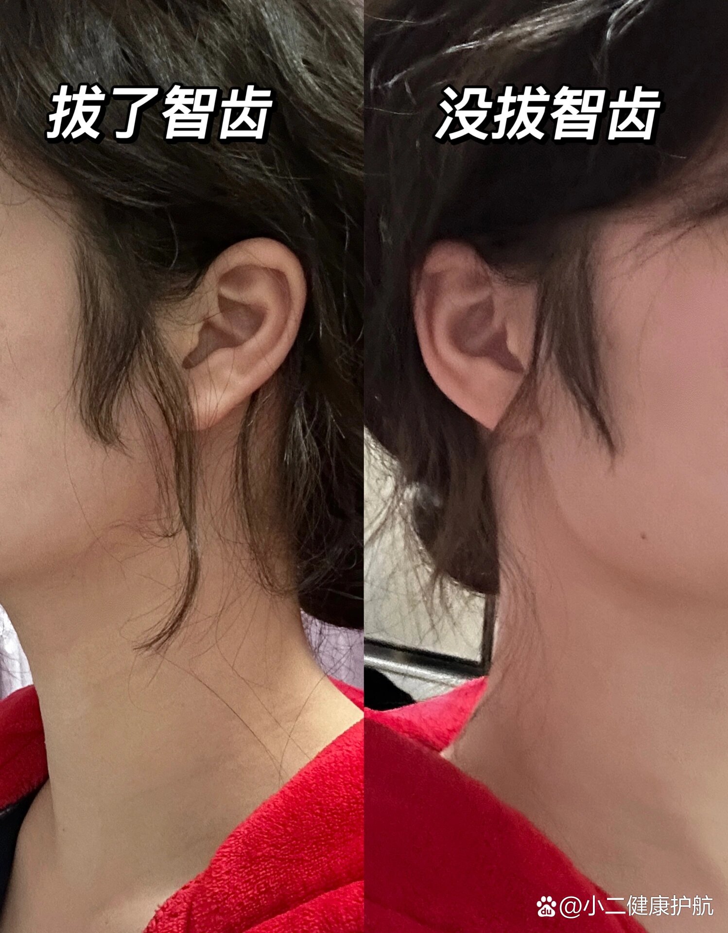 拔完智齿脸变小了!