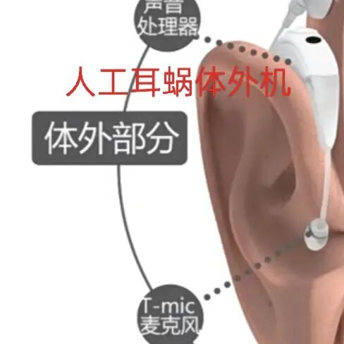 人工耳蜗寿命多长时间图片