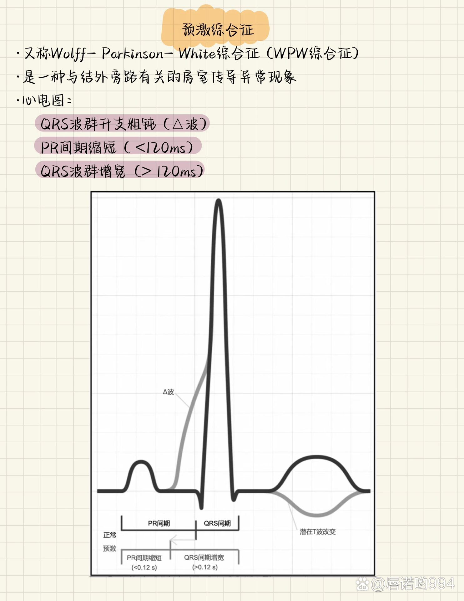 心室预激波心电图特点图片