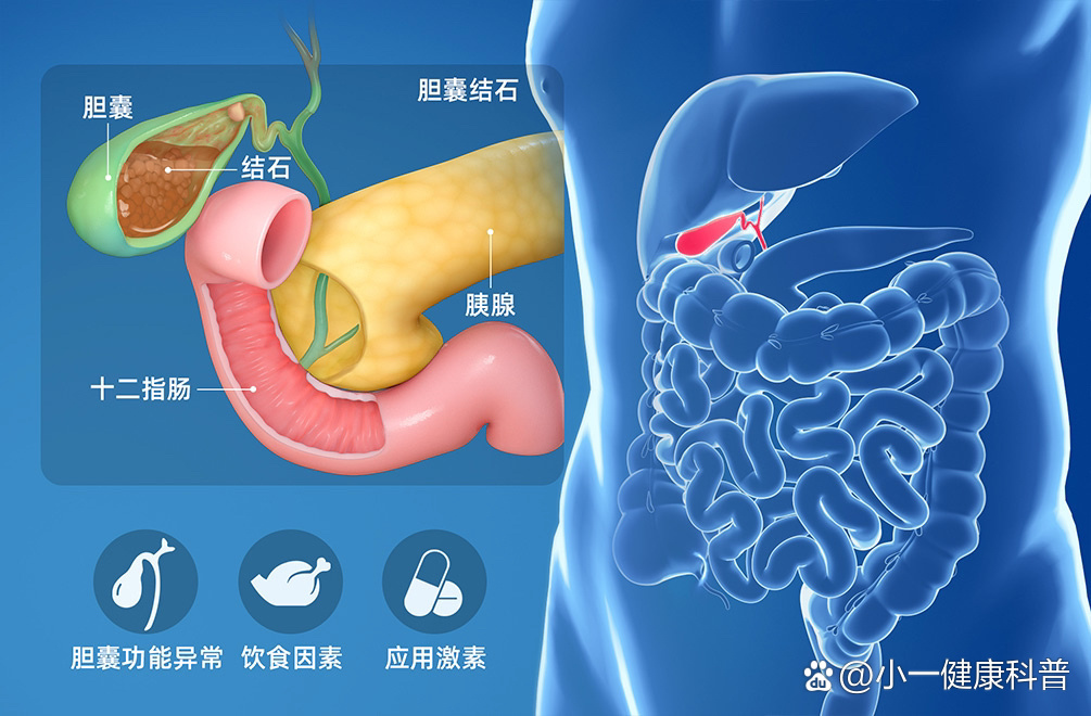 胆囊结石原因图片