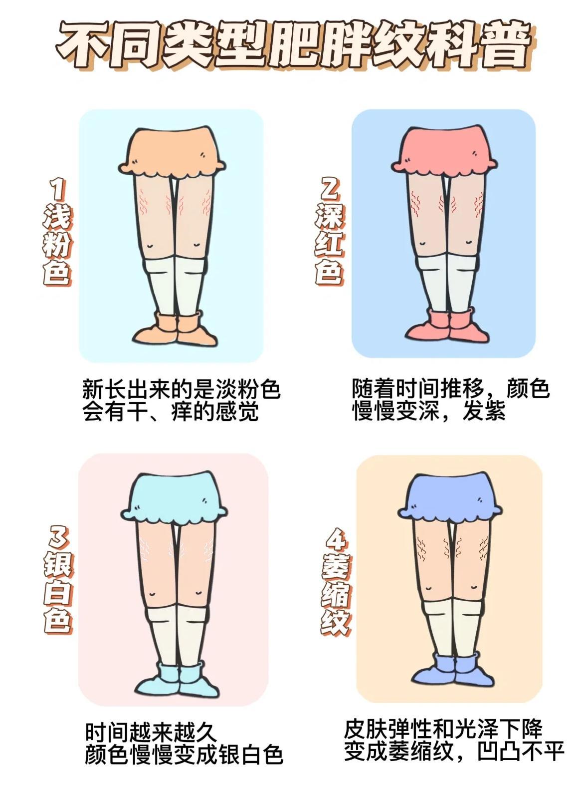 肥胖纹尴尬又焦虑？
