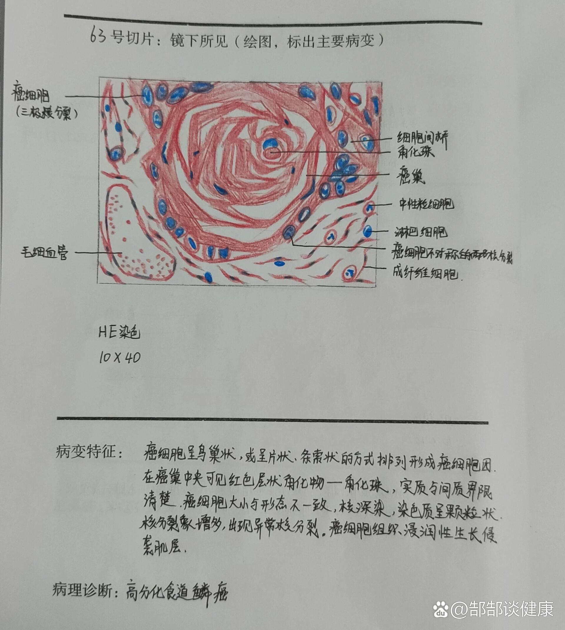 食道癌病理报告图片