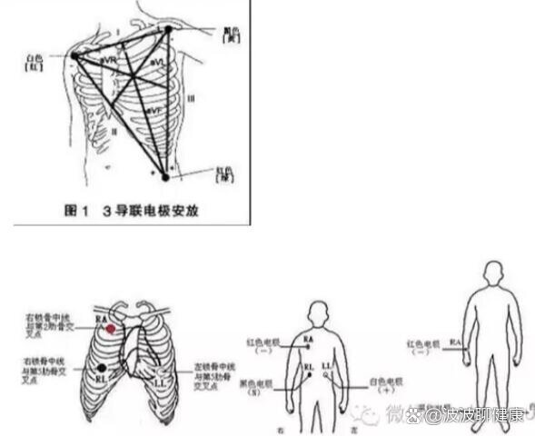 v3rv4rv5r导联位置图片