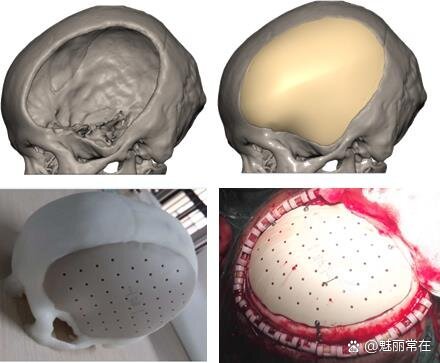 颅骨修补图片