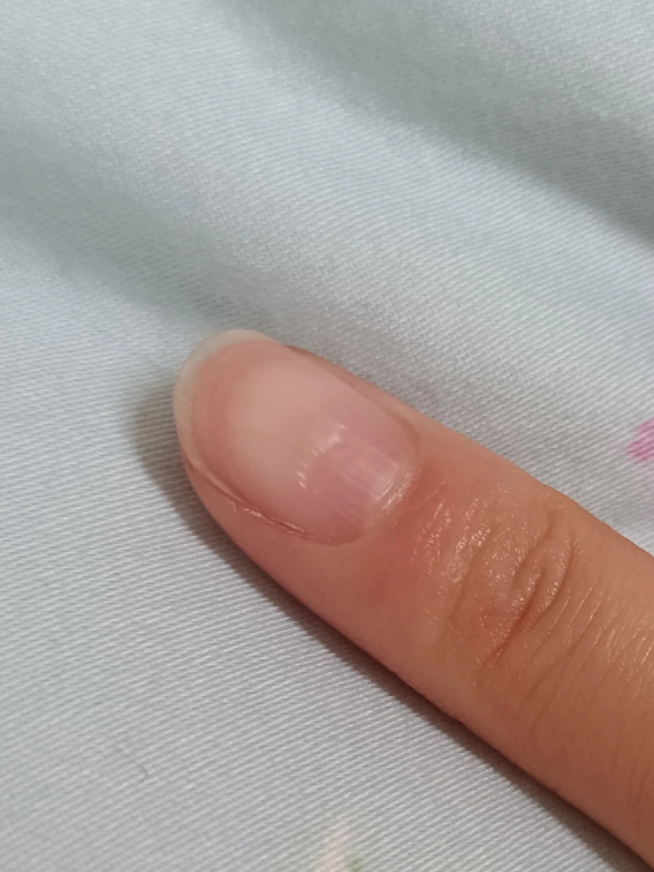 指甲上面有横沟是怎么回事呀