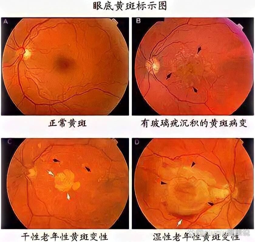 年龄相关性黄斑变性