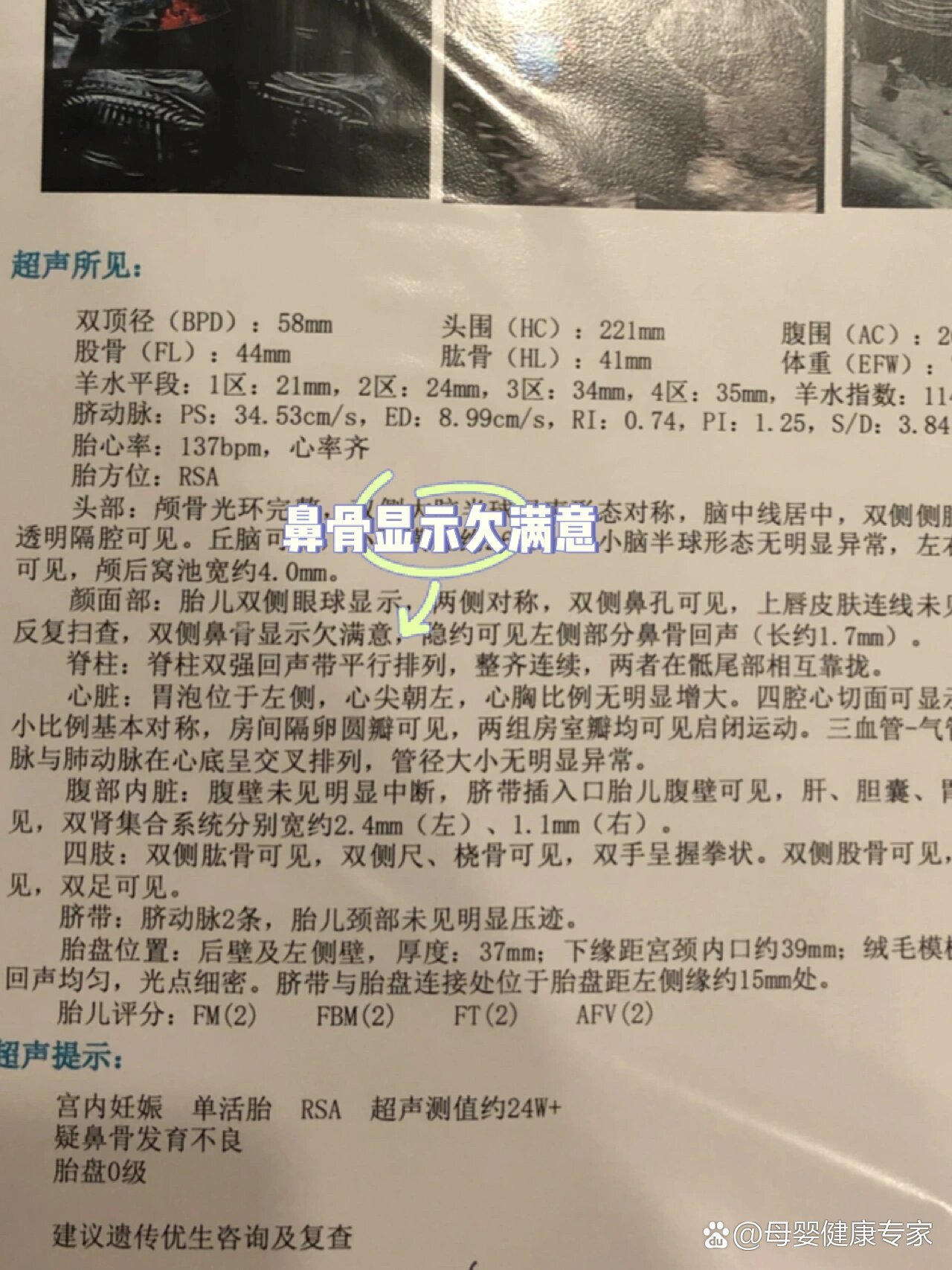 鼻骨发育不良照片图片