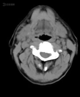 59岁患有声门上型喉癌,经手术治疗恢复良好