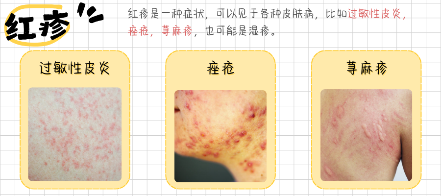 红疹和湿疹的区别是什么如何判别