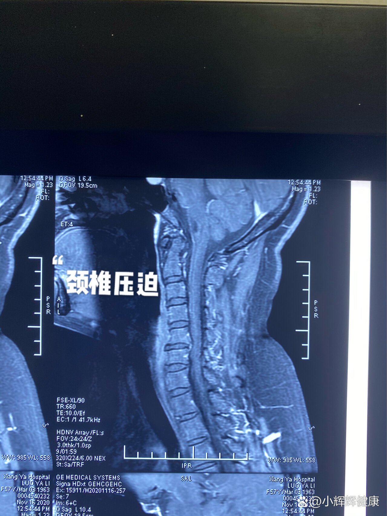 颈椎手术是怎么做的?