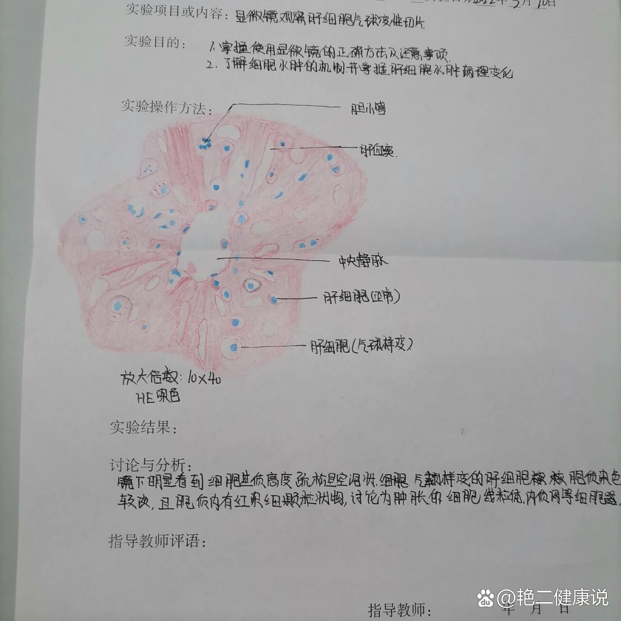 慢性肺淤血手绘图 全网资源