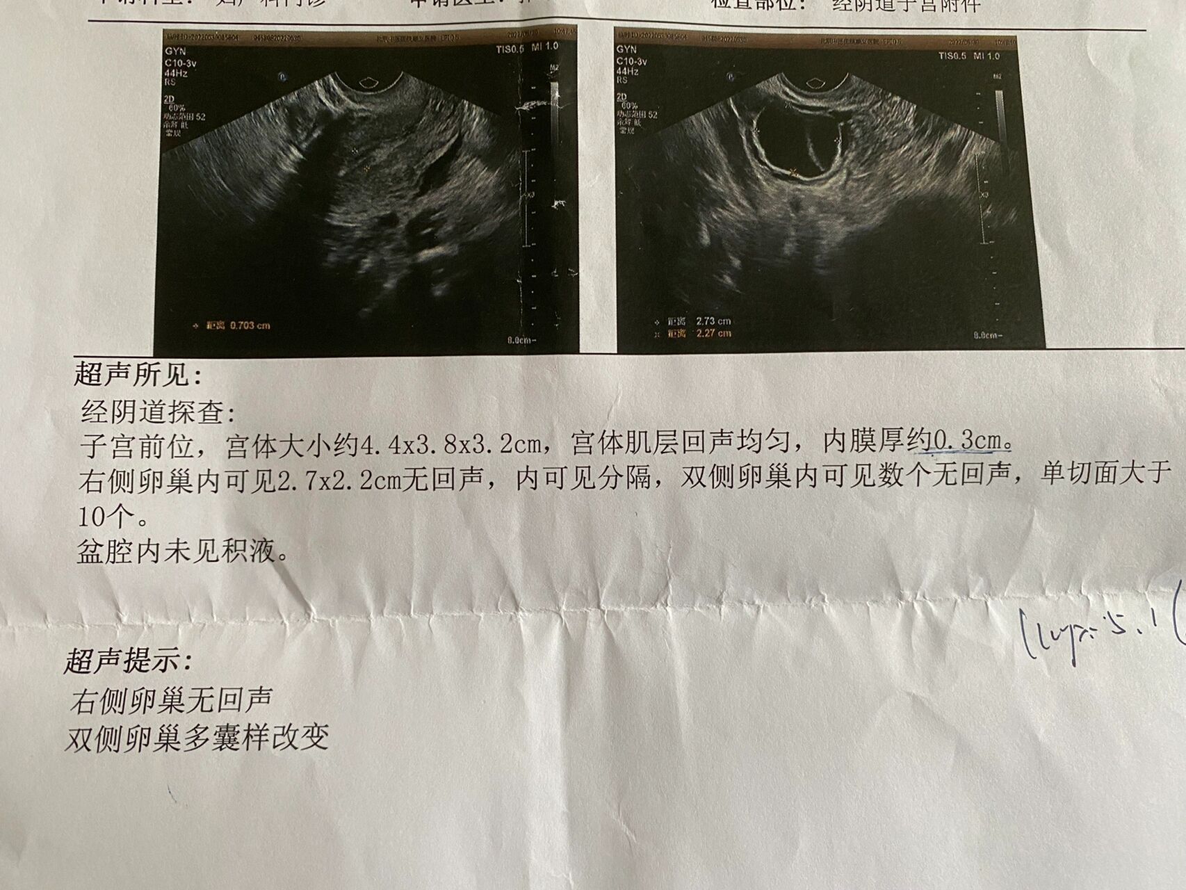 卵巢卵泡样回声(卵巢卵泡回声一般有几个)