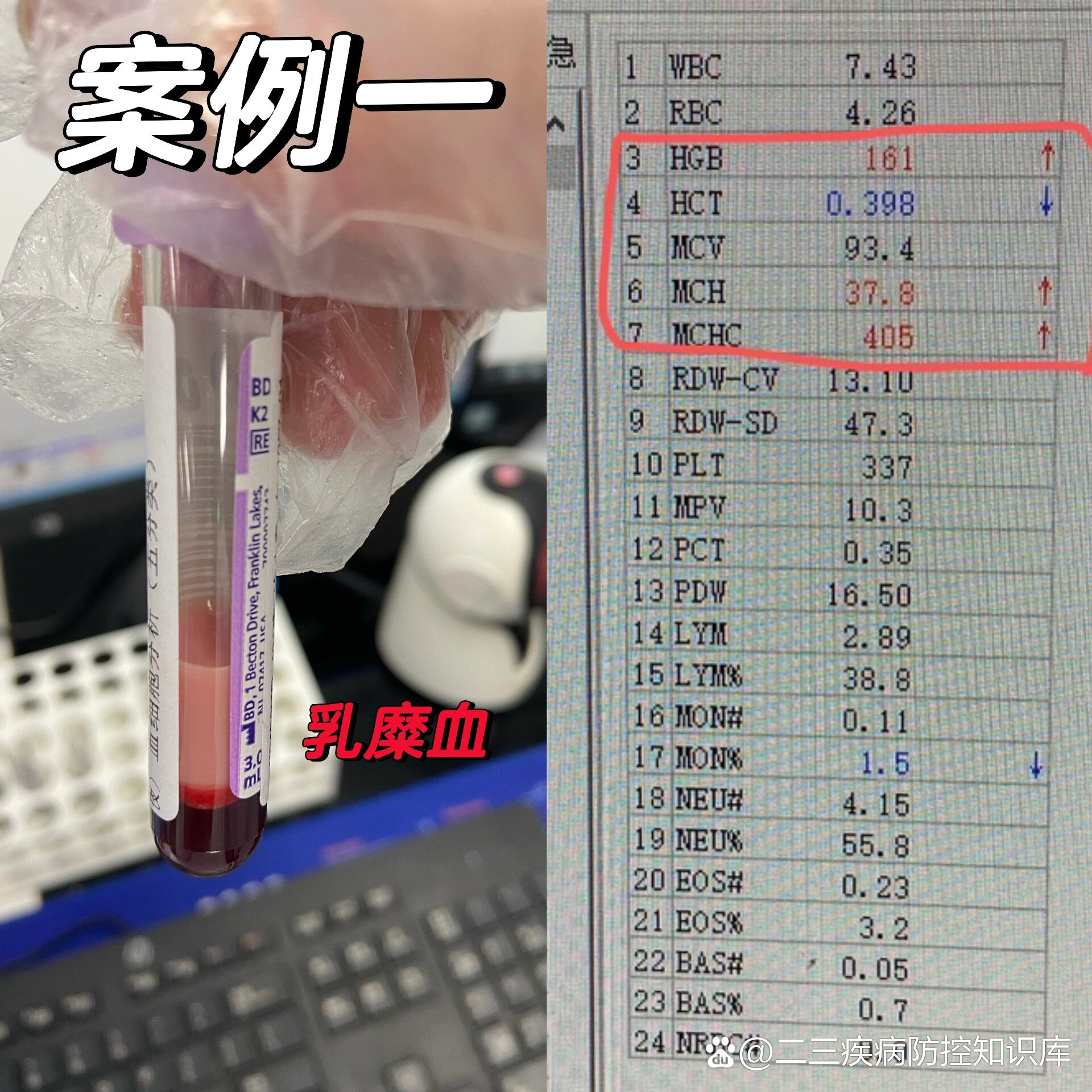 两例脂浊影响血常规结果
