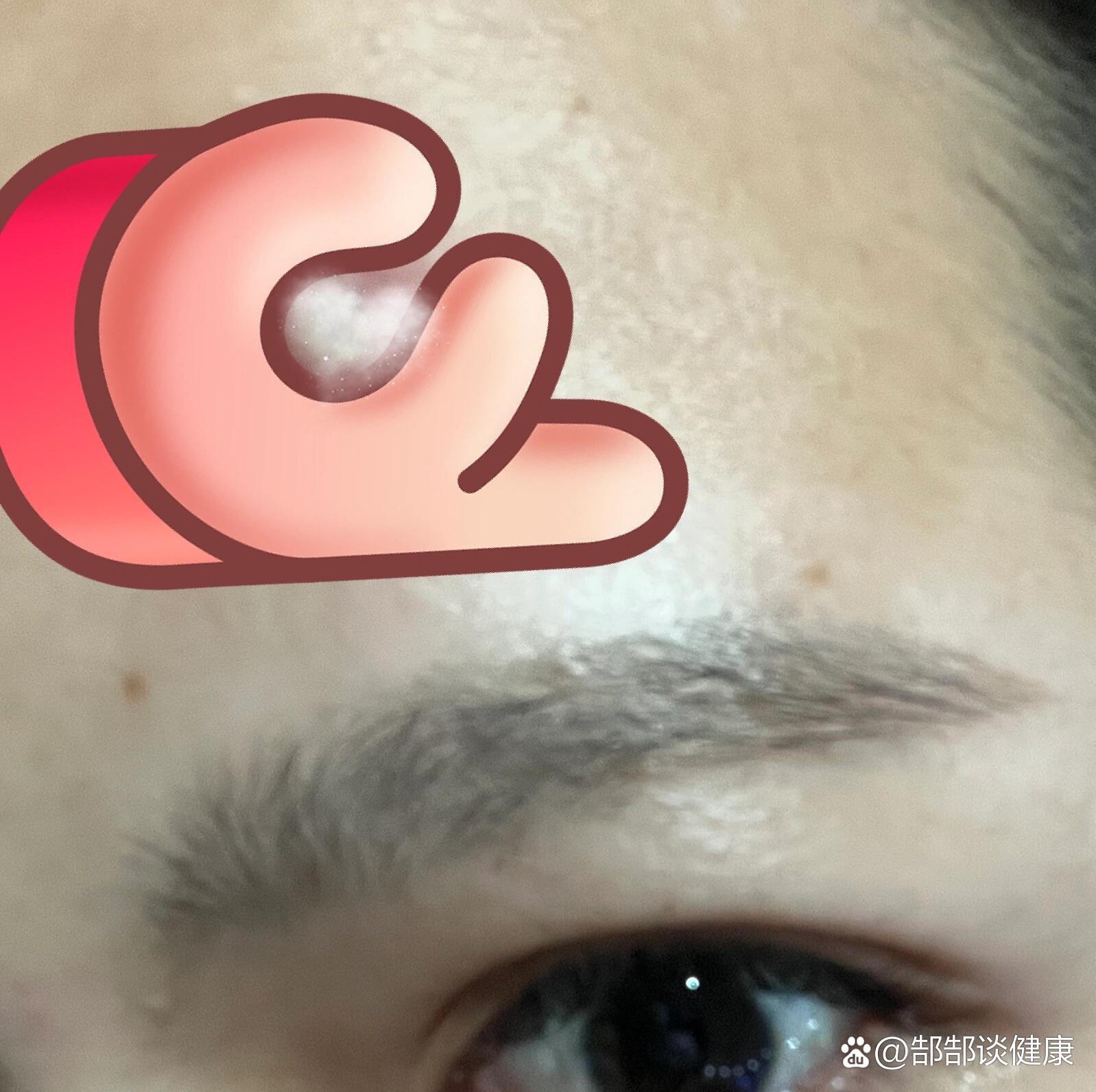 火疖子!