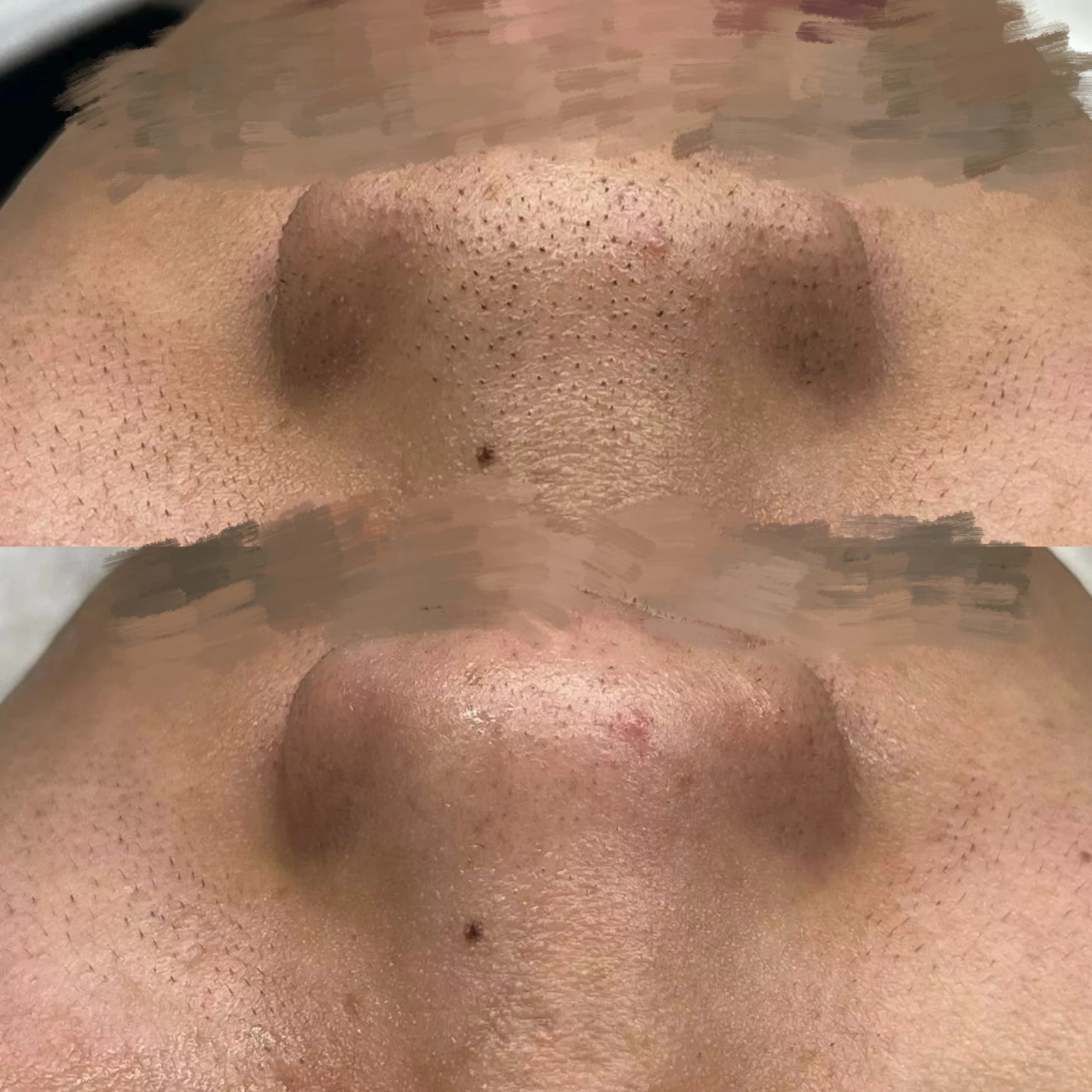 黑头新鲜出炉的男士草莓鼻对比图,清完极度