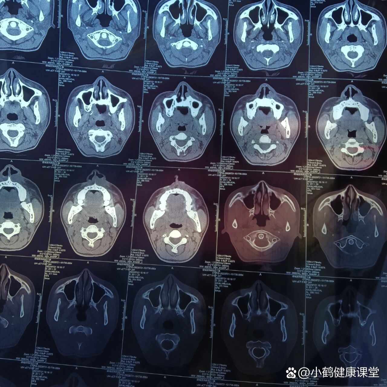 鼻前庭囊肿手术